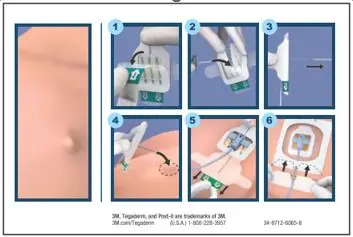 6-step application process for 3M Tegaderm CHG I.V. Port Dressing.
