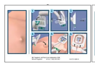 Visual application steps for Tegaderm CHG dressing